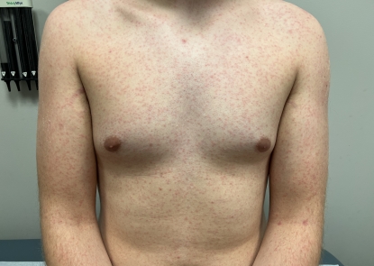 Photo of dengue rash on study volunteer